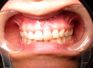 Distracción Alveolar Histogénica