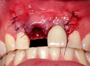Distracción Alveolar Histogénica