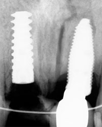 Distracción Alveolar Histogénica