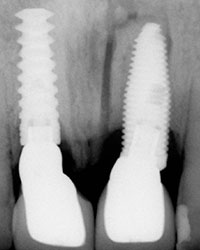 Distracción Alveolar Histogénica