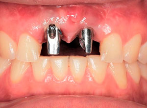 Distracción Alveolar Histogénica