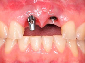 Distracción Alveolar Histogénica