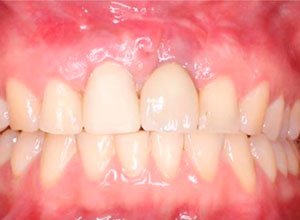 Distracción Alveolar Histogénica