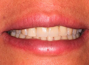 Distracción Alveolar Histogénica