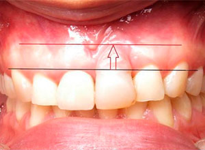 Distracción Alveolar Histogénica
