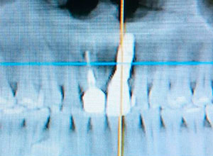 Distracción Alveolar Histogénica