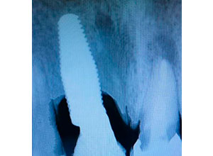 Distracción Alveolar Histogénica