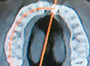 Distracción Alveolar Histogénica