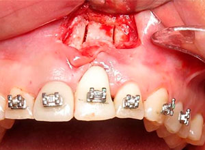 Distracción Alveolar Histogénica