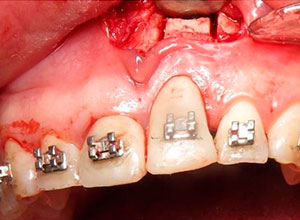 Distracción Alveolar Histogénica