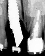 Distracción Alveolar Histogénica