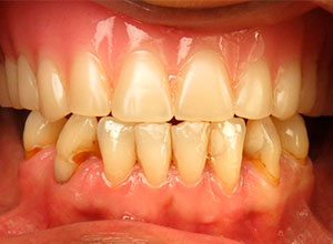 Edentulismo Caso Clínico