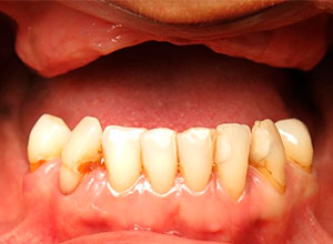 Edentulismo Caso Clínico