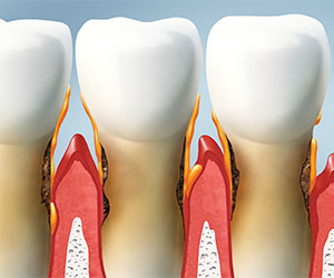 Enfermedad Periodontal