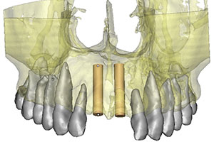 Trauma alveolar