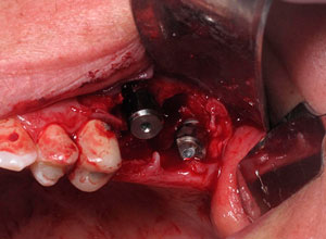 Implantes Dentales Pterigoideos con Injerto