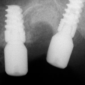 Implantes Dentales Pterigoideos con Injerto