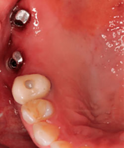 Implantes Dentales Pterigoideos con Injerto