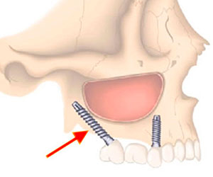 Implantes Dentales Pterigoideos con Injerto
