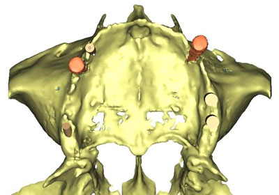 Implantes Dentales pterigoideos