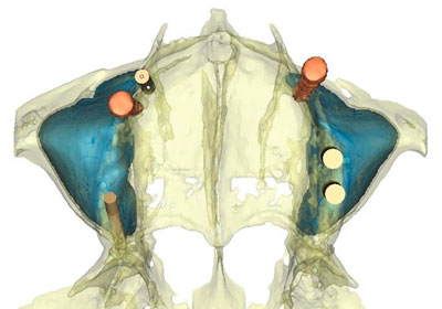 Implantes Dentales pterigoideos