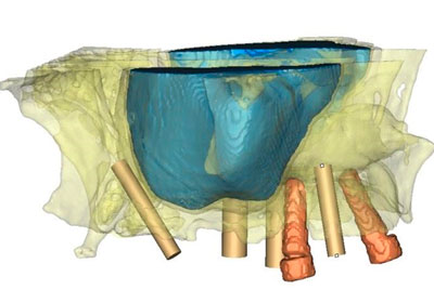 Implantes Dentales pterigoideos