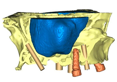 Implantes Dentales pterigoideos
