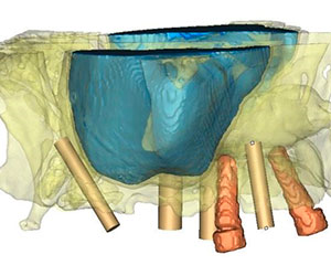 Implantes Dentales Pterigoideos