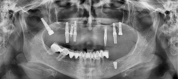 Implantes dentales Rx