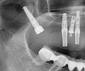 Implantes dentales Rx
