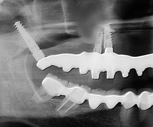 Implantes dentales Rx