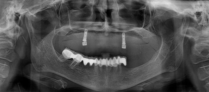 Implantes dentales pterigoideos