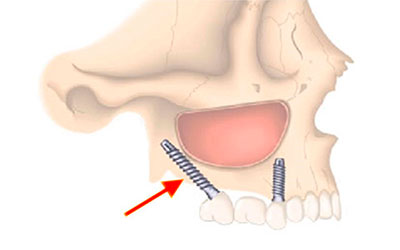 Implantes dentales pterigoideos