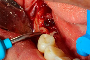 Injerto Oseo - Caso Clínico