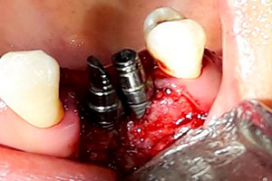 Injerto Oseo - Caso Clínico