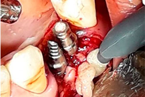 Injerto Oseo - Caso Clínico