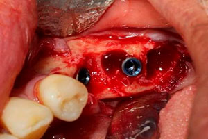 Injerto Oseo - Caso Clínico