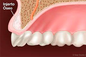 Injerto Oseo