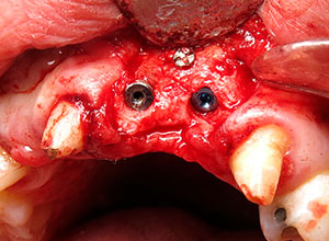 Injerto de rama ascendente mandibular