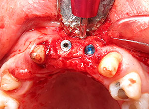 Injerto de rama ascendente mandibular