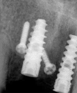 Injerto de rama ascendente mandibular