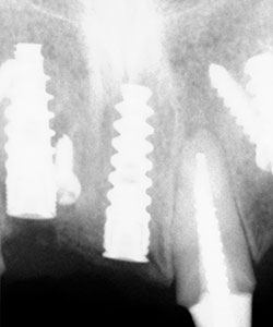 Injerto de rama ascendente mandibular