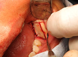 Injerto de rama ascendente mandibular