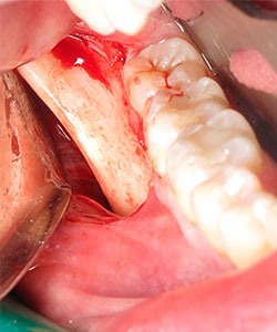 Injerto de rama ascendente mandibular