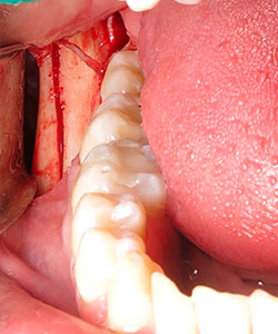 Injerto de rama ascendente mandibular