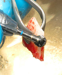 Injerto de rama ascendente mandibular