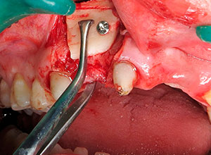 Injerto de rama ascendente mandibular