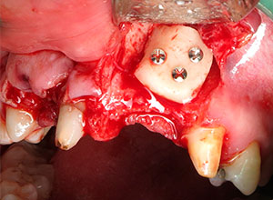 Injerto de rama ascendente mandibular