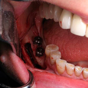 Lateralización implantes dentales