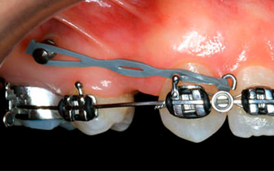 Ortodoncia en Implantología Dental » DR. MOLINA MOGUEL 2 Ortodoncia en Implantología Dental